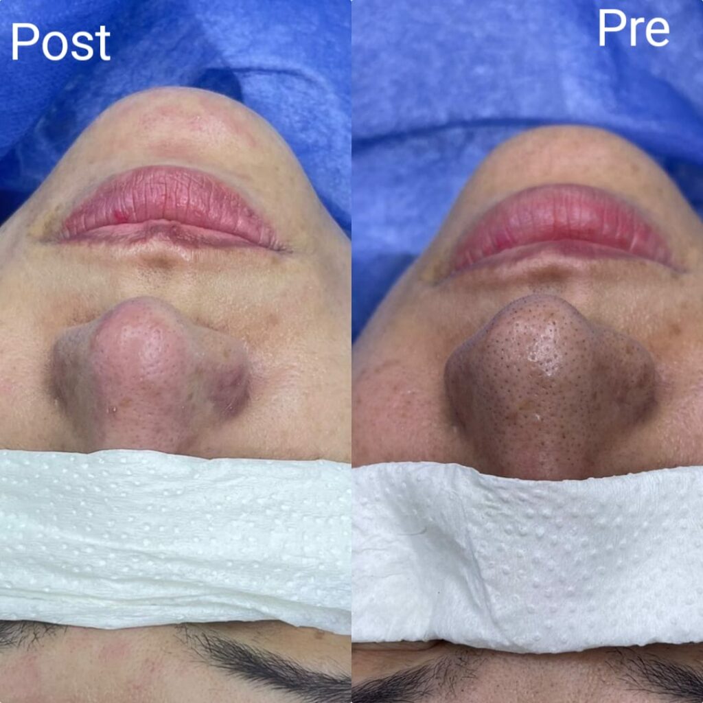 Blackheads treatment on the nose before and after